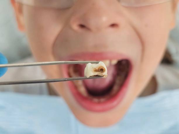 Best Emergency Root Canal Treatment in Buchanan, MI