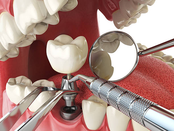 Best Emergency Tooth Extraction in Buchanan, MI